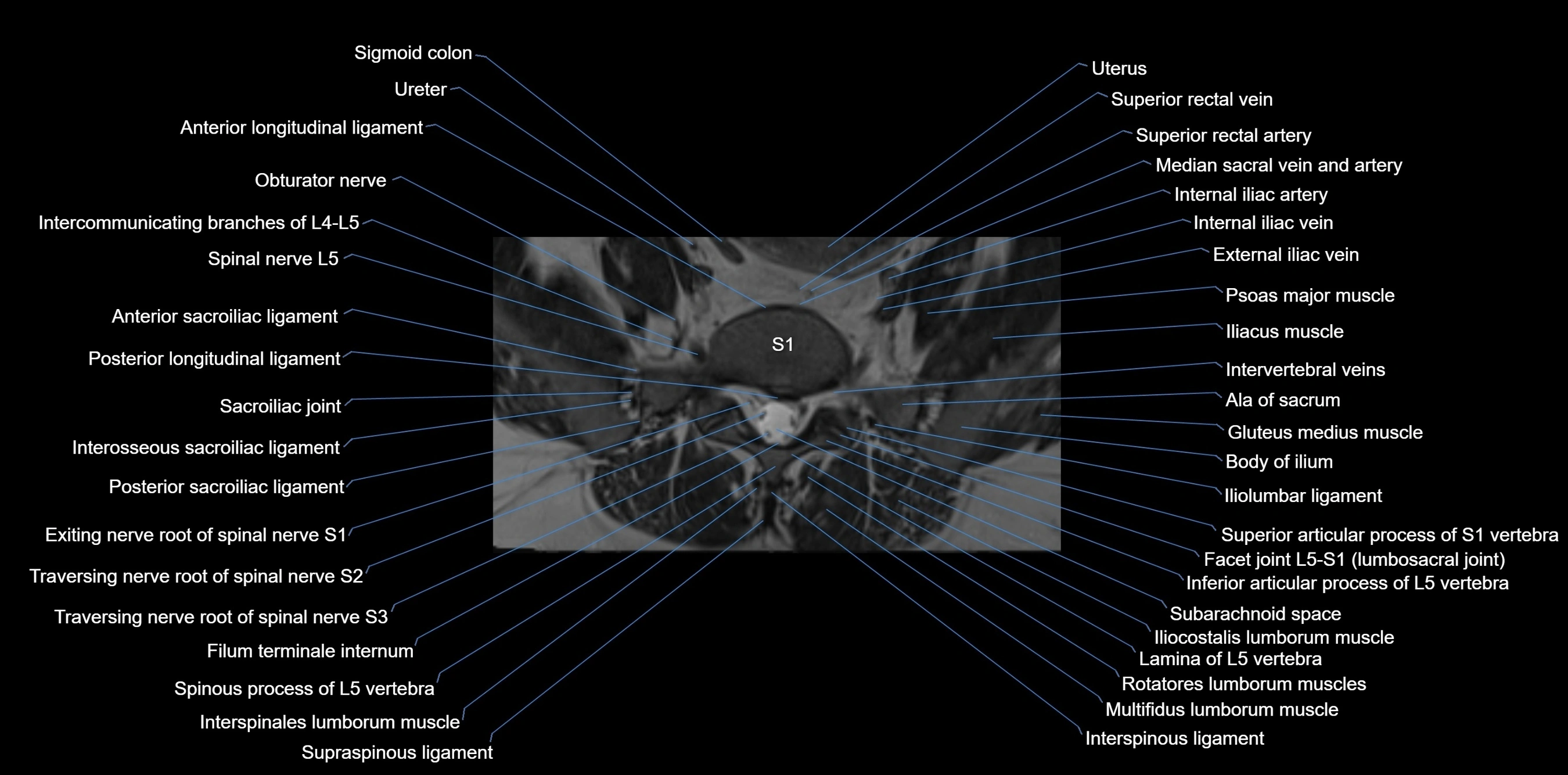 MRI sacrum, coccyx and sacroiliac joint axial cross sectional anatomy 3T  radiology  image-img-00001-00008.webp